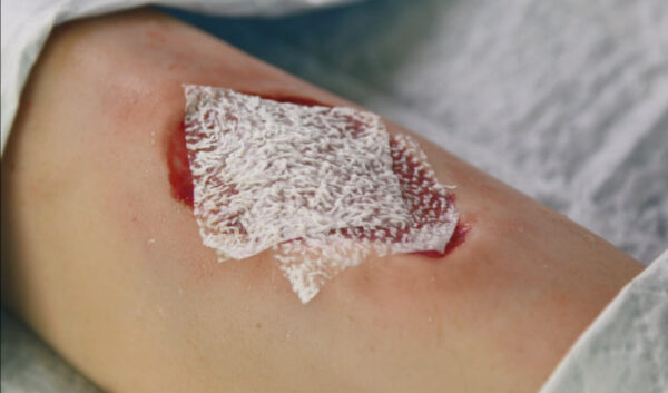 Endoform™ Natural Restorative Bioscaffold - Image 4